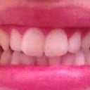 My smile - before