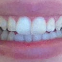 My smile - tray #6