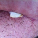 wound