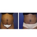 Before and 3 months after surgery! Yeahhhhhhhhhhhh