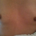 This is before shot. One boob looks higher because I am holding the camera up. Front picture.