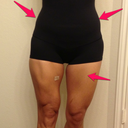 The arrows show where I have some of my swelling,  Even though I had no work done on my legs the swelling traveled down into my thighs. So they are not as defined as they should be.