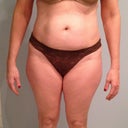 front 5 days pre op