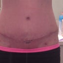 4 week PO for extended tummy tuck and Lipo.