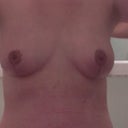 4 week PO for breast lift.