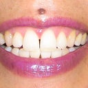 after zoom whitening