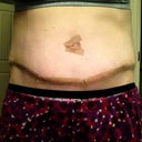 12 days post op TT