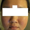 Skin is more scaly.
Flaking has reduced.
Redness is all over.
Big pimple near lip.
Small tiny pimples are going away or are gone.