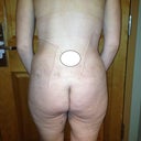 11 days post op worried abot lipo suction areas, cannot see a difference:(