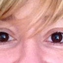 2 Weeks After 1st Injection