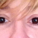 2 Weeks After 1st Injection