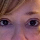 3 Days After 2nd Injection