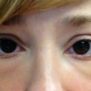 6 Days After 2nd Injection