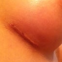 Incision - 3 weeks postop.