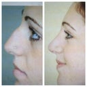 Before & after (about 3 months after surgery; still showing some swelling)