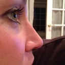 2 weeks after shots. I notice that the stubborn swelling has come down on the profile :)
