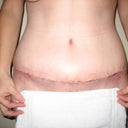 3 weeks post op