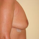 Day 3 Post Op Side View