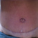 scar around bottom half of belly button