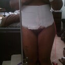 Day 1 post-op front