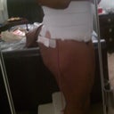 Day 1 post-op other side