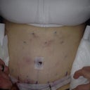 1st day Post op picture yikes, looks like a shark attack! this was a painful day..