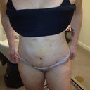 5 days post op in office visit, starting to feel a tiny bit better