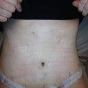 9 days post op in office standing up straight for the first time and saw my waist and swelling was gone! feeling discomfort but no pain. off pain pills now!