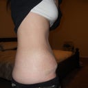 3 weeks post op