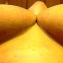 t-junctions - 9 months post op