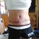 4 Week Post op of belly and Scars.