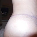 3 week scar right