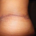 3 week revision scar left