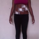 AFTER front (post 4 days)