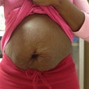 Pre-Op (Front View) Can't wait to say good bye to this!!!!
