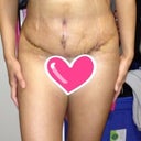 Standing semi straight and slanted so its hard to see my true shape. I'm obviously Super swollen still, but I can already tell my sides are smaller. I ended up with a vertical scar to cover my old BB because I had no more skin to pull. But my new Bb is very small and cute , that was one of my biggest concerns . Boobs are healing well and everyone says they look perfect for my size. I'm happy I didn't go any bigger. I think they suit  my petite-ness well :)