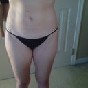 Final 6 mos after 2nd procedure