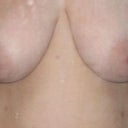 Before Breast Reduction Surgery
