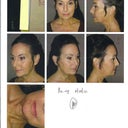Before surgery