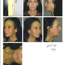 Two months later. Smooth neck, no more jowls,shape of jawline completely different
