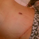3 days post op morning belly.