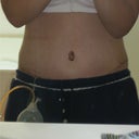 Post Op 1 week today