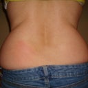 Back view, pre treatment