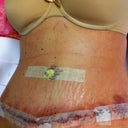 1 day post op