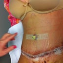1 day post op