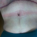 2 months out- a little swollen and pretty red but it will improve with time!