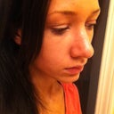one month 16 days.. can kind of see the bump on my bridge in the picture.