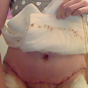 3Days post op I didnt take all the bandage off takes to long to put back on. I am rather swollen today. I hope that I dont get a dog ear it kind of looks like one but I am rather swollen...:(