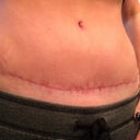 4 months post op