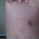Here's a photo showing the bruising on my outer thighs one week after Ultrashape treatment.
